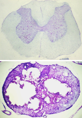 spinal cord injury